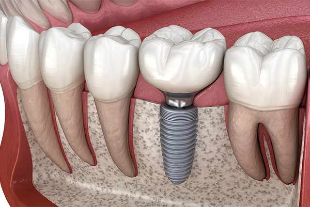 Park Slope Dental Aesthetics | Implant Restorations, TMJ Disorders and Smile Makeover